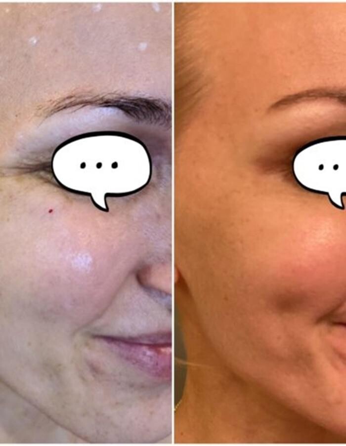 Images Injections By Sabina