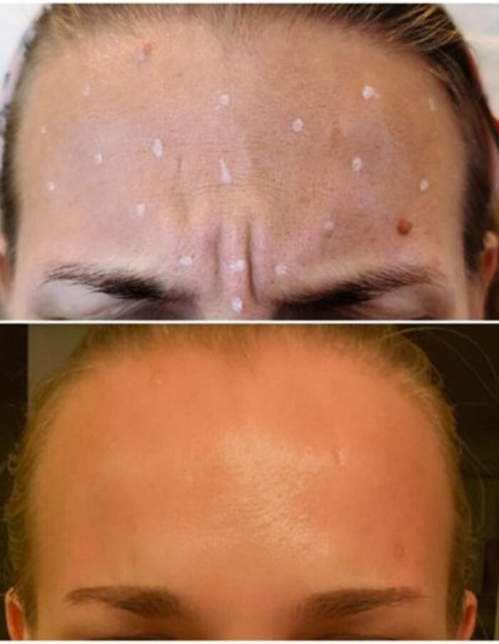 Images Injections By Sabina