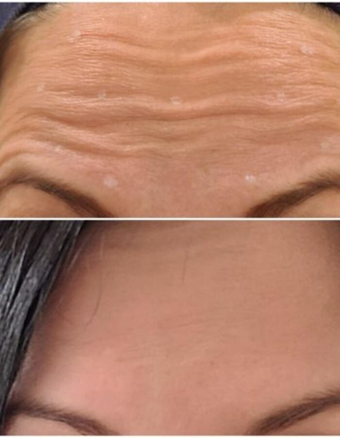Images Injections By Sabina