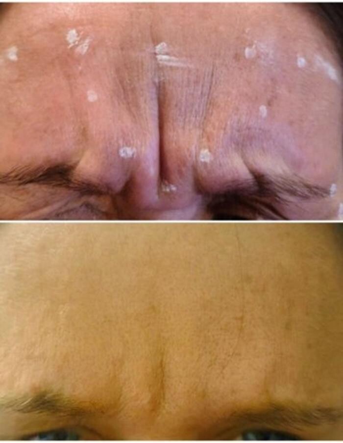 Images Injections By Sabina
