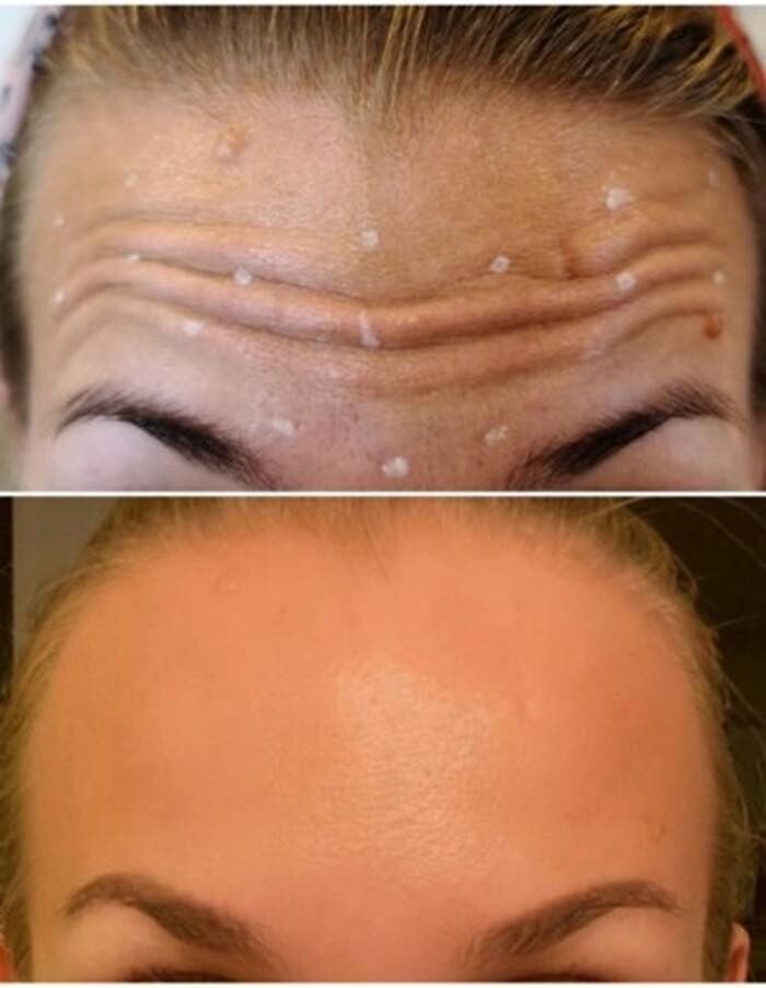 Images Injections By Sabina