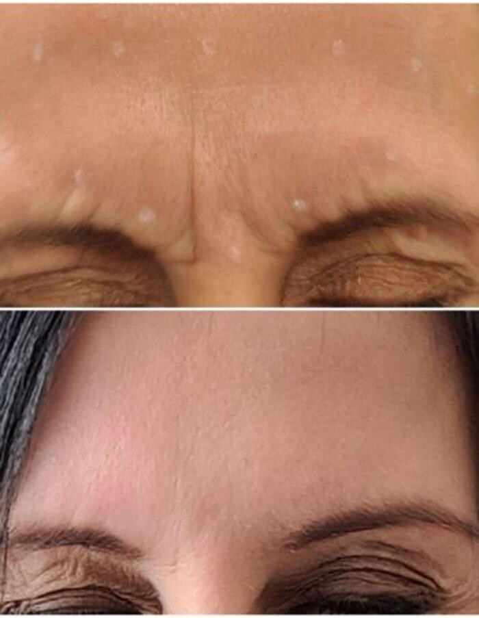 Images Injections By Sabina