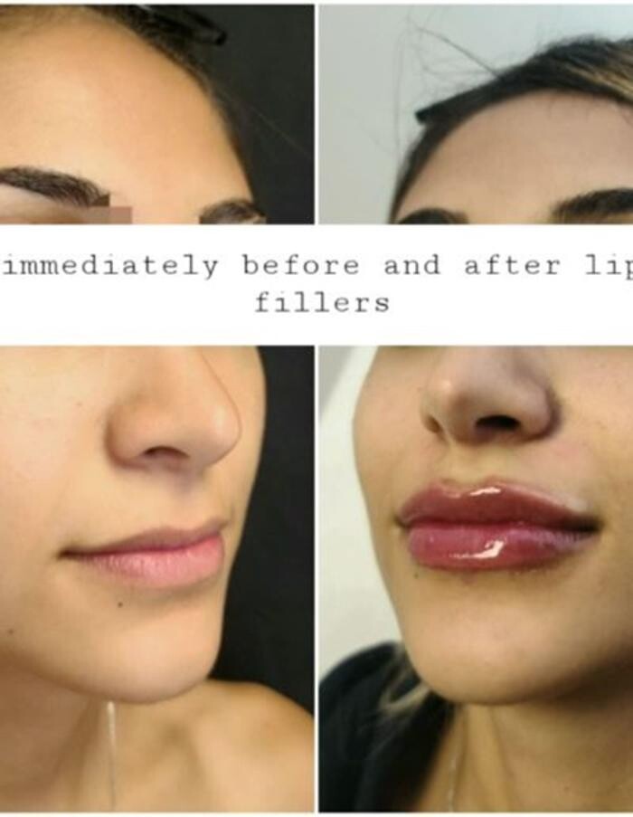 Images Injections By Sabina