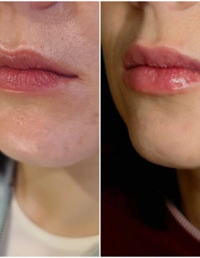 Images Injections By Sabina