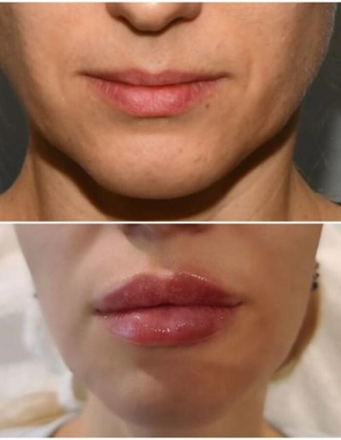 Images Injections By Sabina