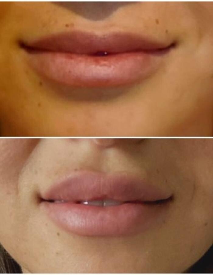 Images Injections By Sabina