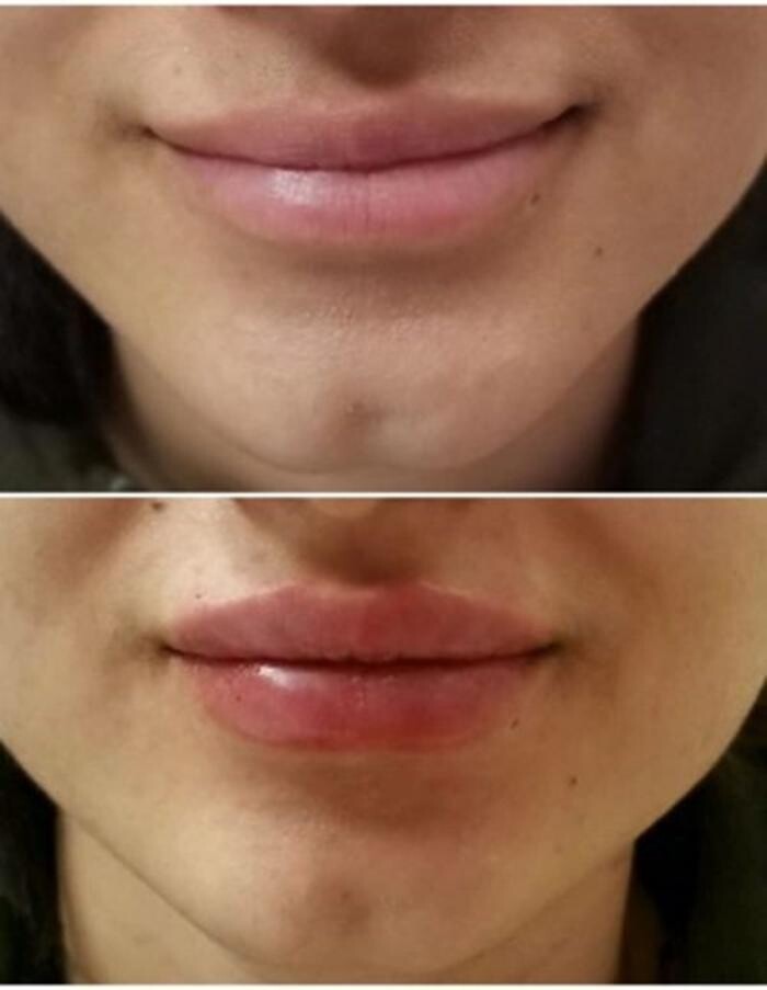 Images Injections By Sabina
