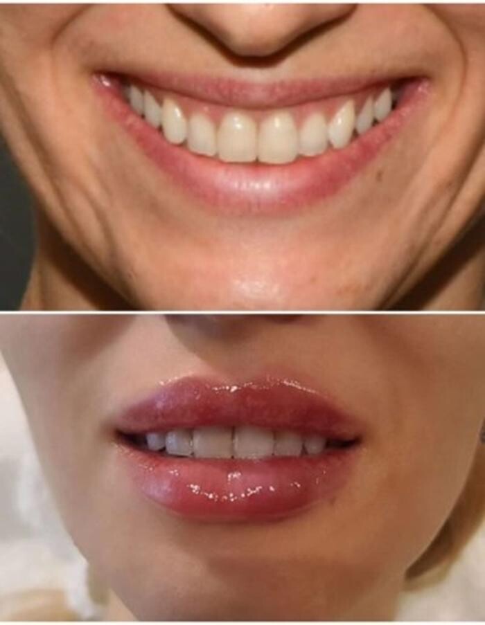 Images Injections By Sabina