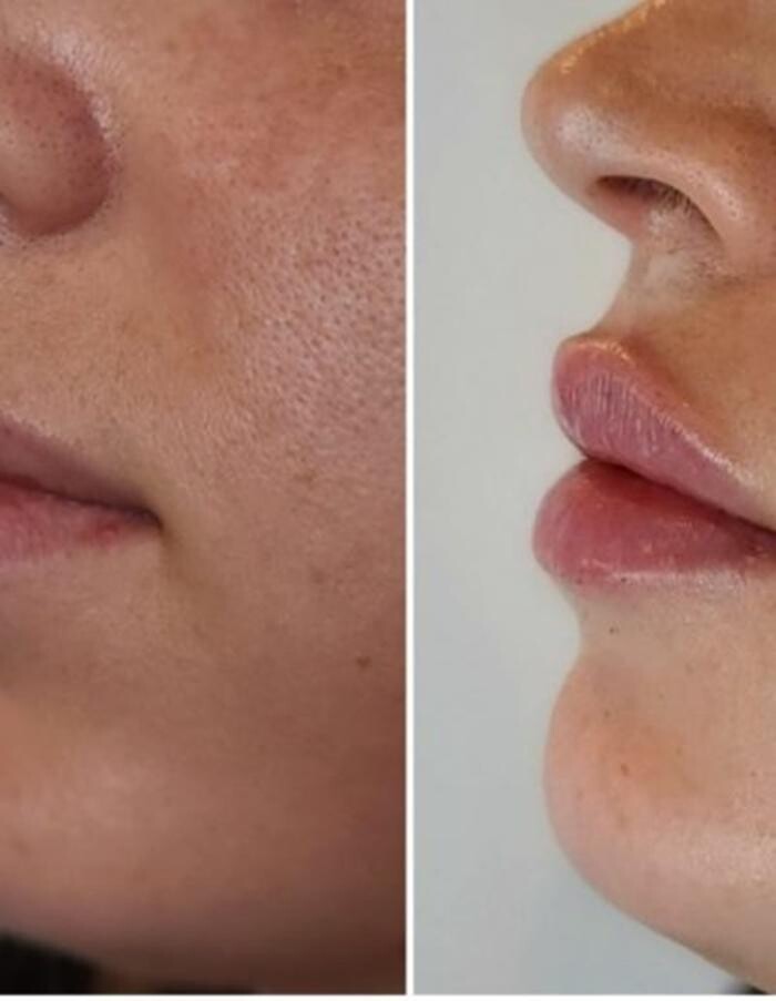 Images Injections By Sabina