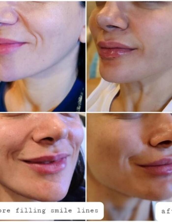 Images Injections By Sabina