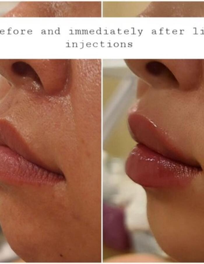 Images Injections By Sabina