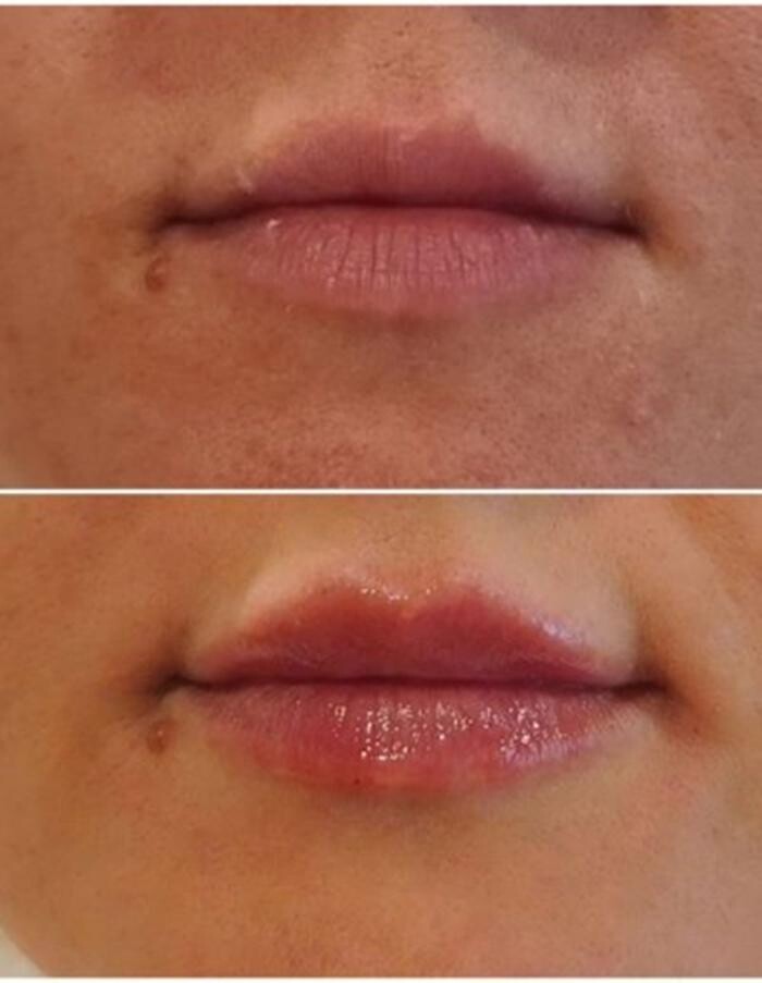 Images Injections By Sabina