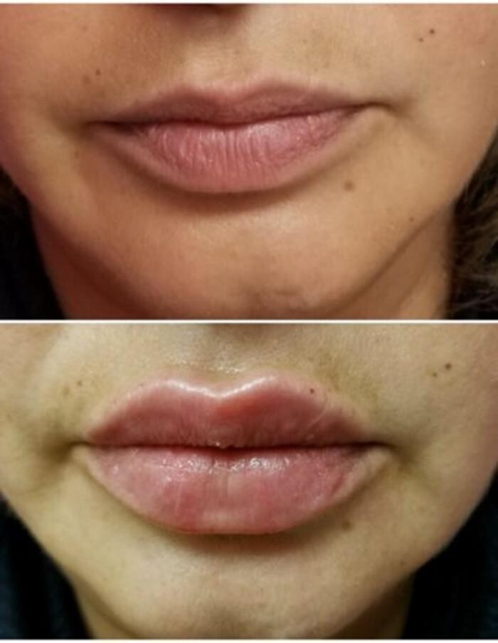 Images Injections By Sabina
