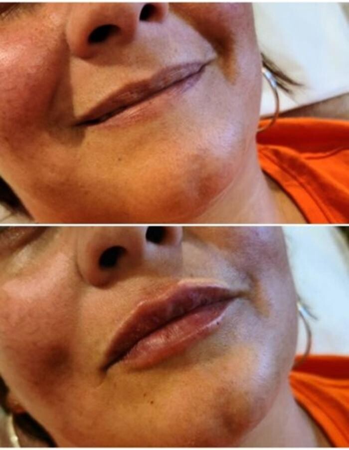 Images Injections By Sabina