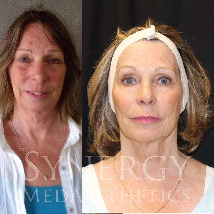 Images Synergy MedAesthetics