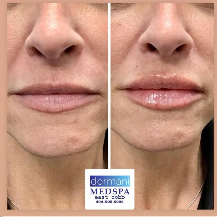 Images dermani MEDSPA East Cobb