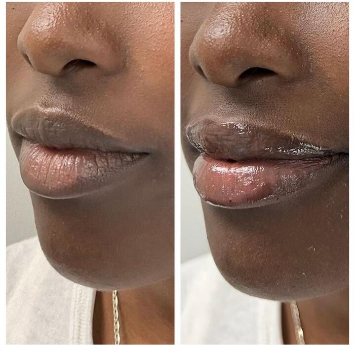 Images dermani MEDSPA East Cobb