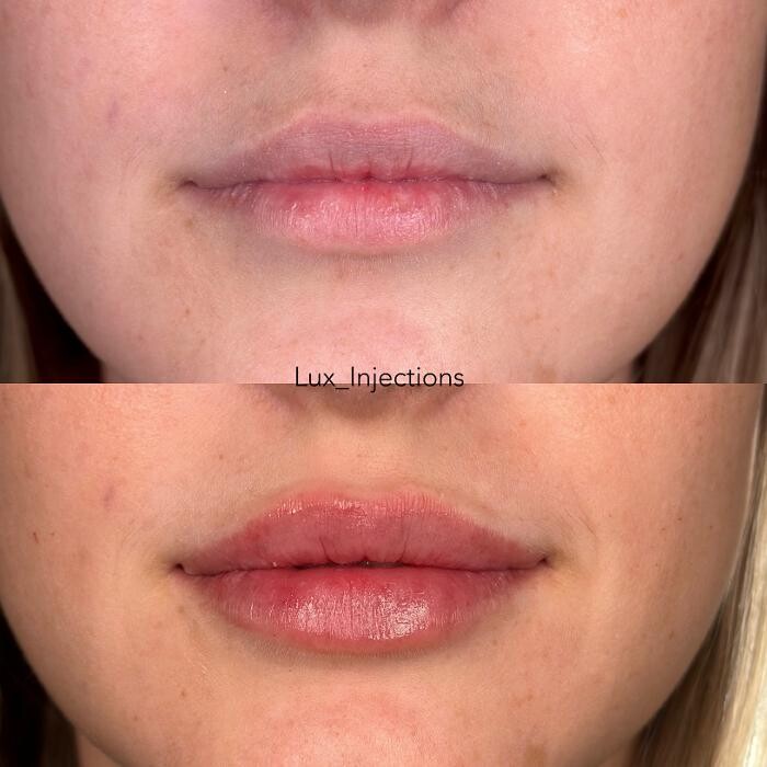 Images Lux Injections