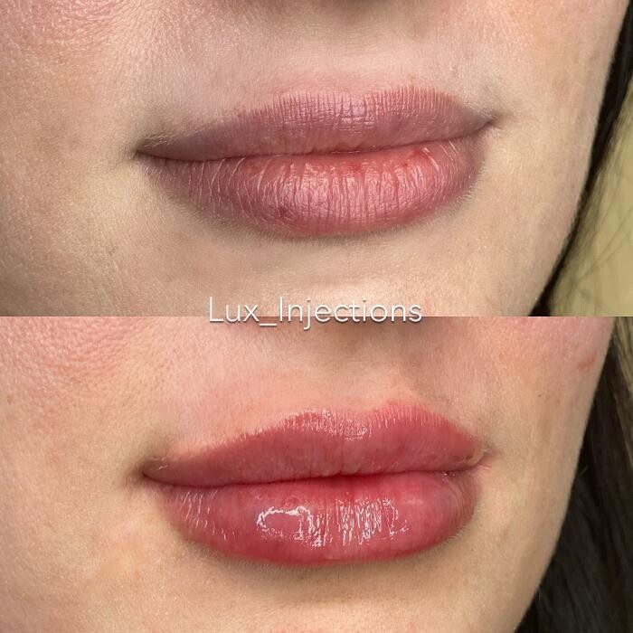 Images Lux Injections