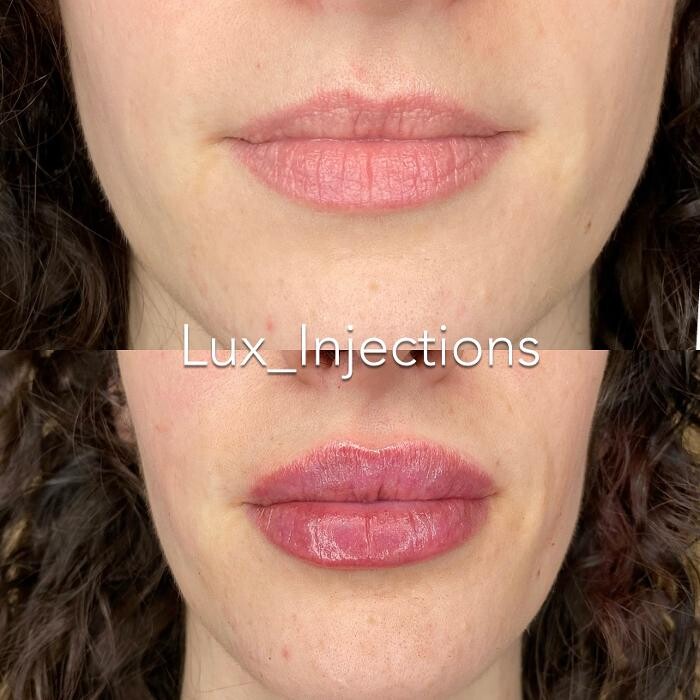 Images Lux Injections