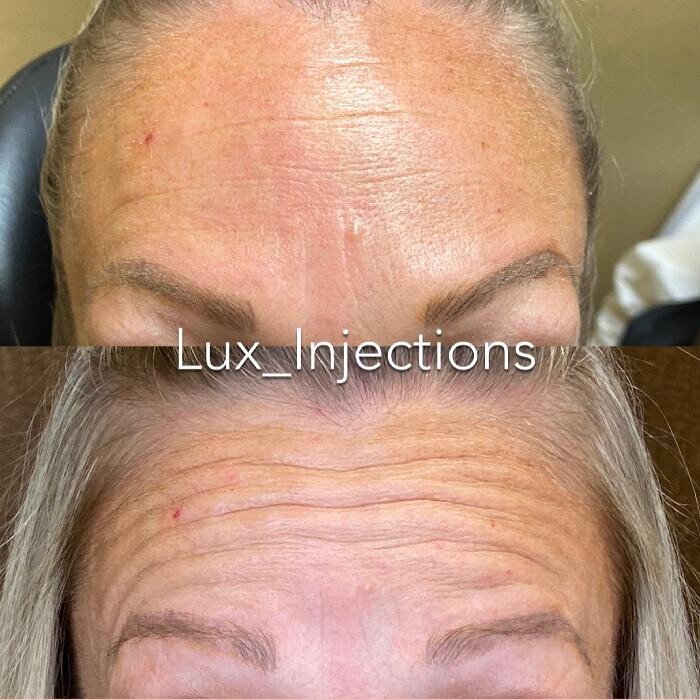 Images Lux Injections