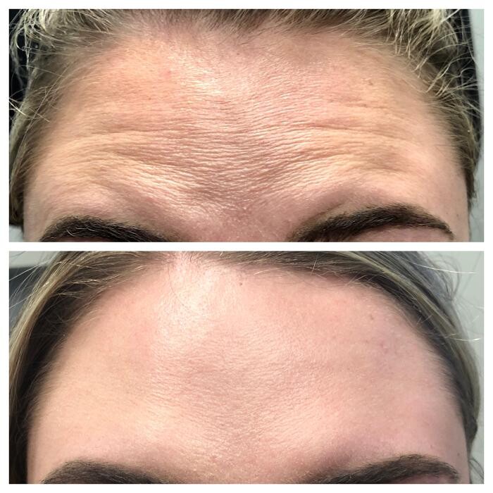 Images Lux Injections
