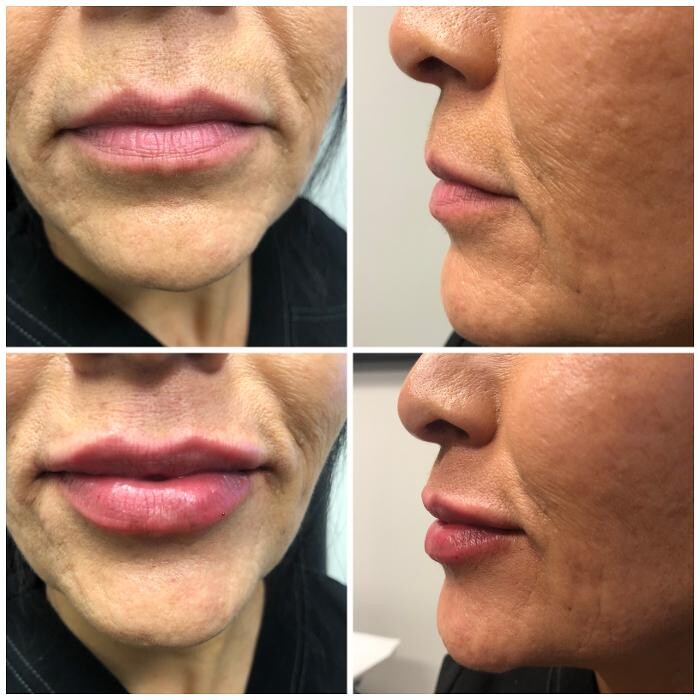 Images Lux Injections