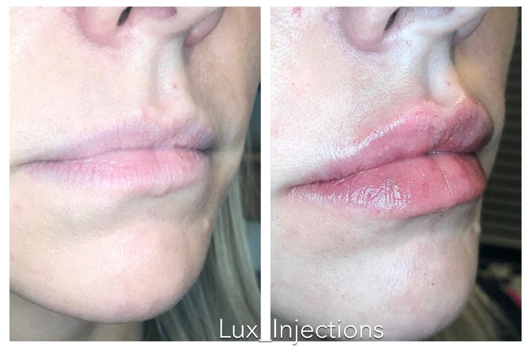 Images Lux Injections