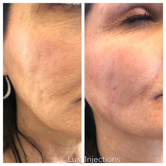 Images Lux Injections