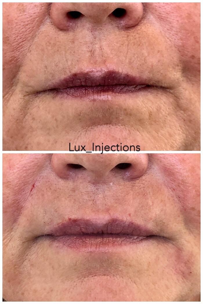 Images Lux Injections