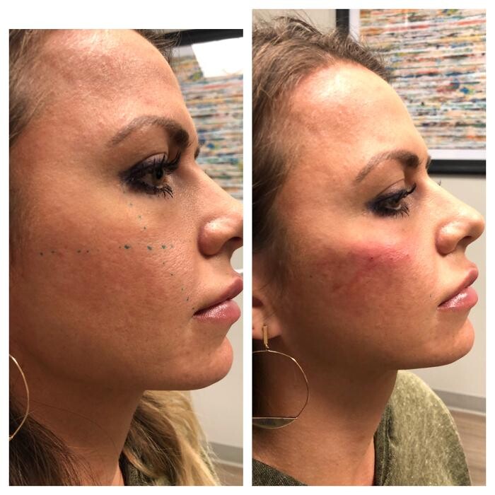 Images Lux Injections