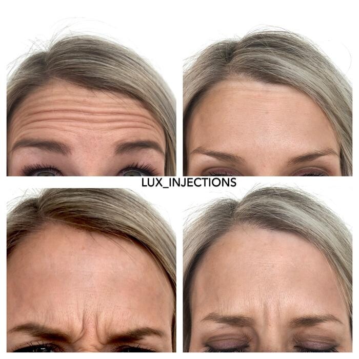 Images Lux Injections