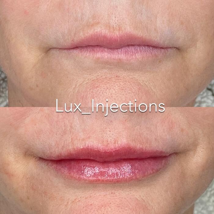 Images Lux Injections