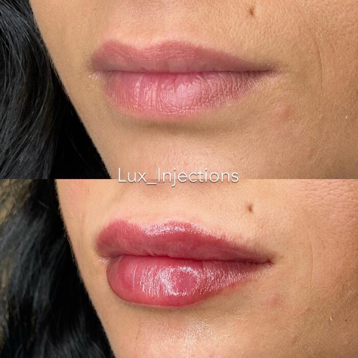 Images Lux Injections