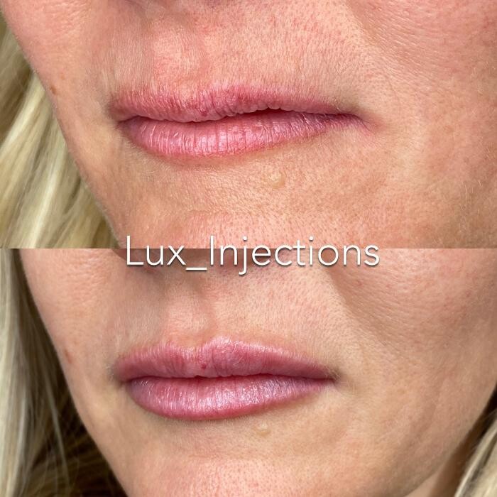 Images Lux Injections