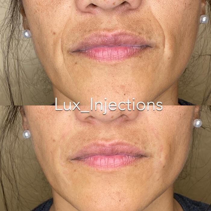 Images Lux Injections