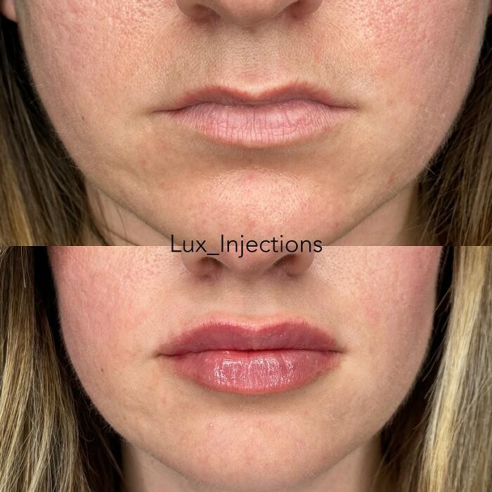 Images Lux Injections