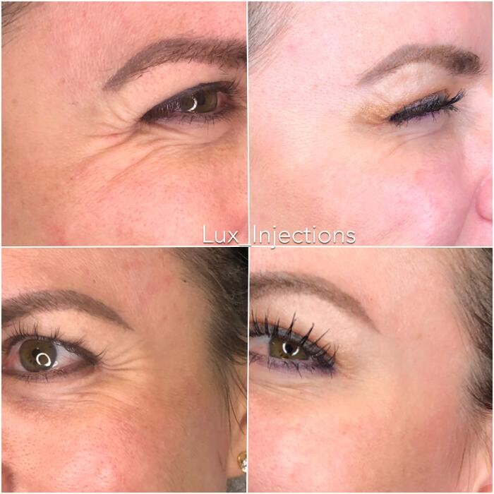 Images Lux Injections