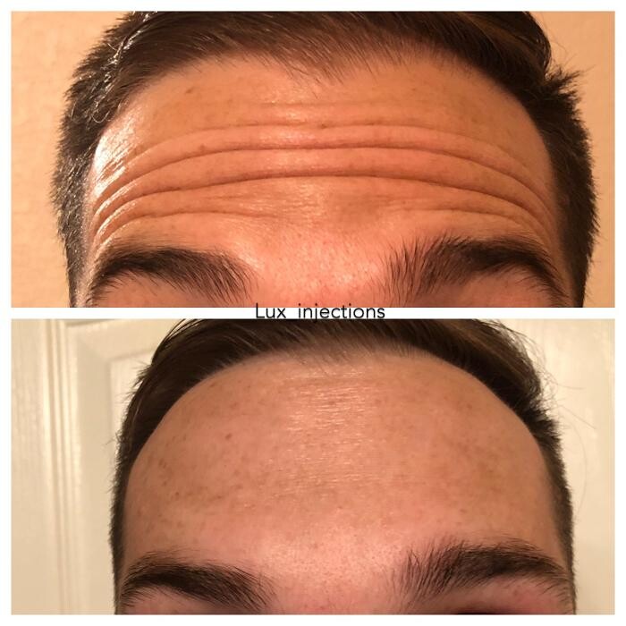 Images Lux Injections