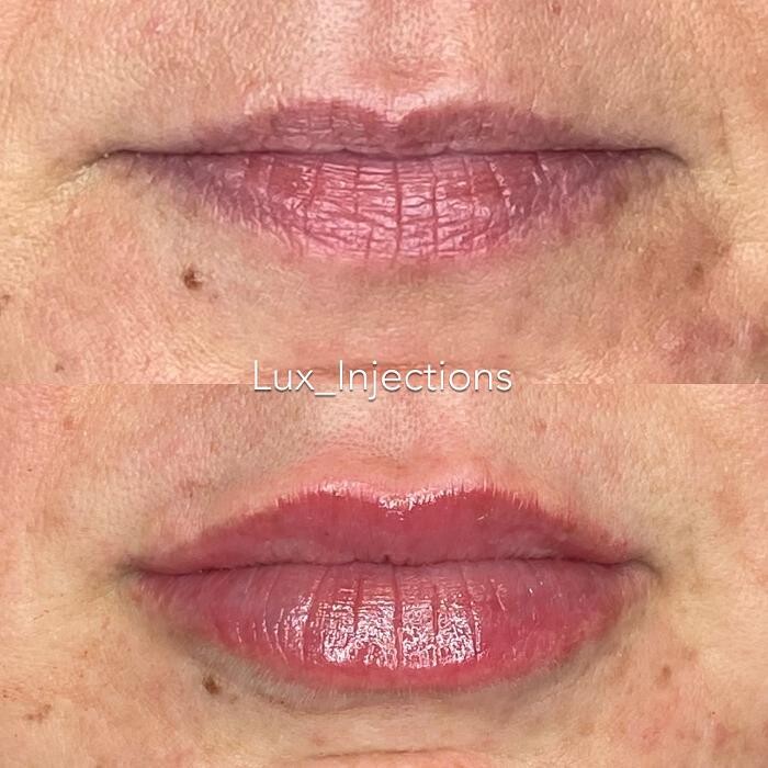 Images Lux Injections