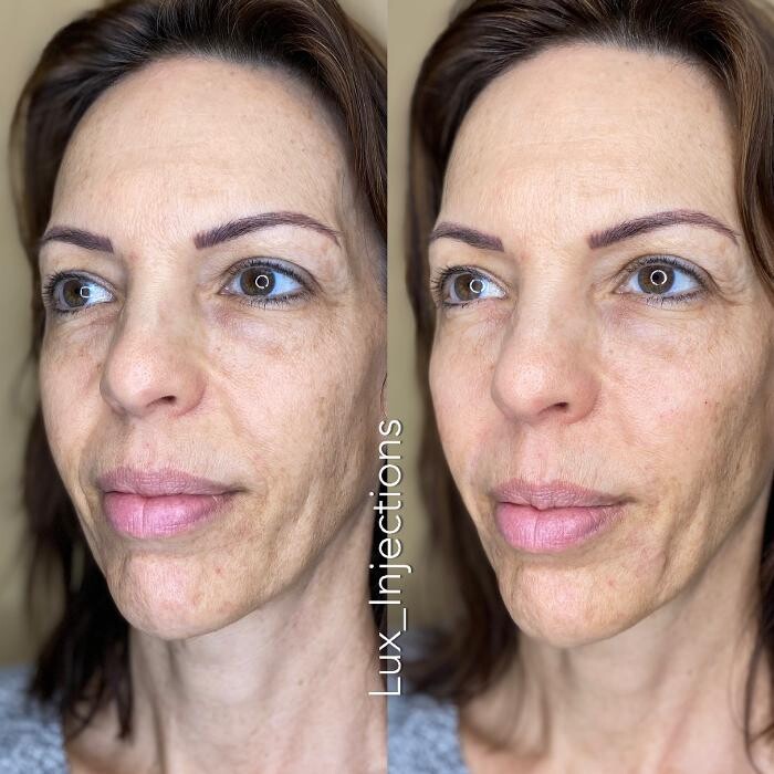 Images Lux Injections