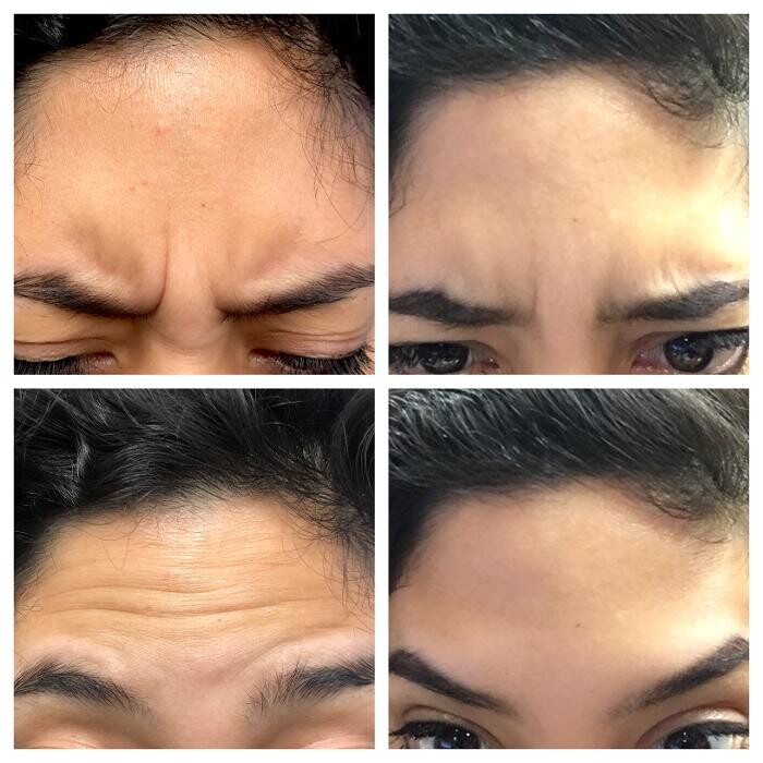 Images Lux Injections