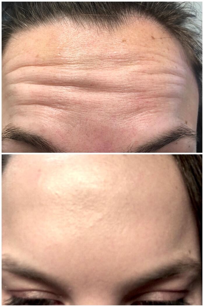 Images Lux Injections