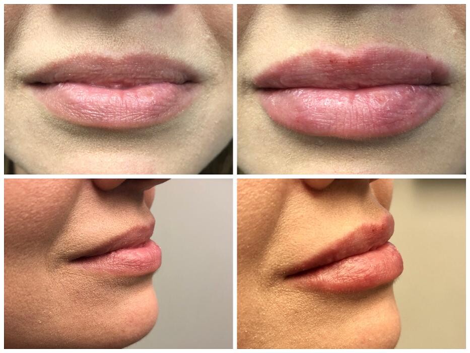 Images Lux Injections