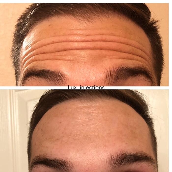 Images Lux Injections