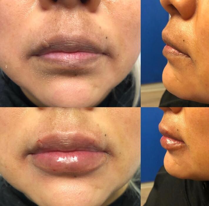 Images Lux Injections