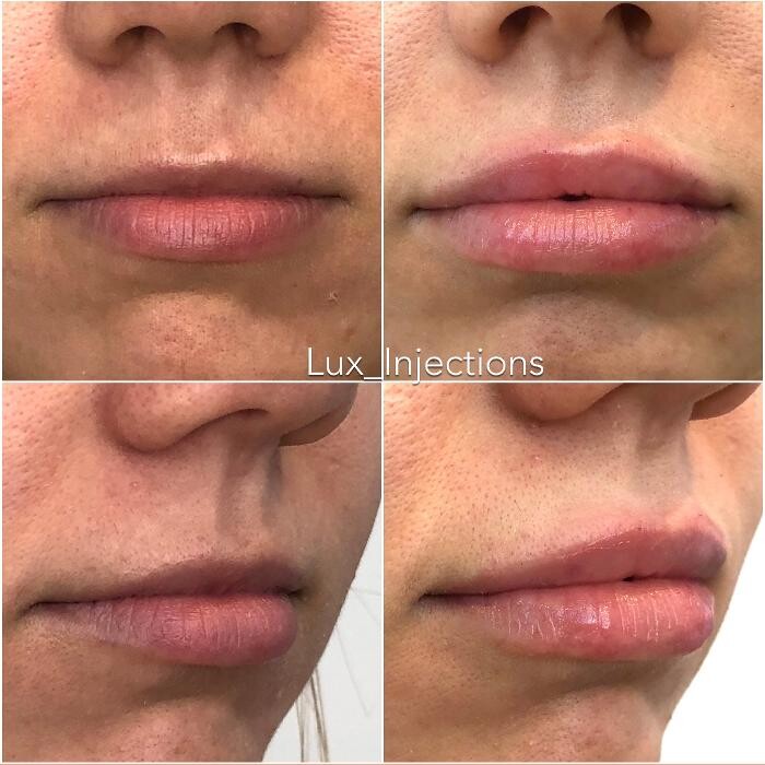 Images Lux Injections
