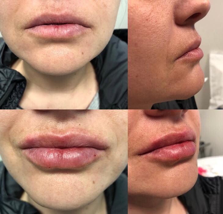 Images Lux Injections