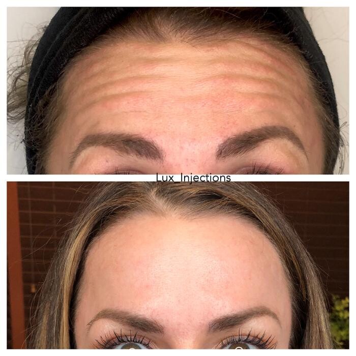 Images Lux Injections