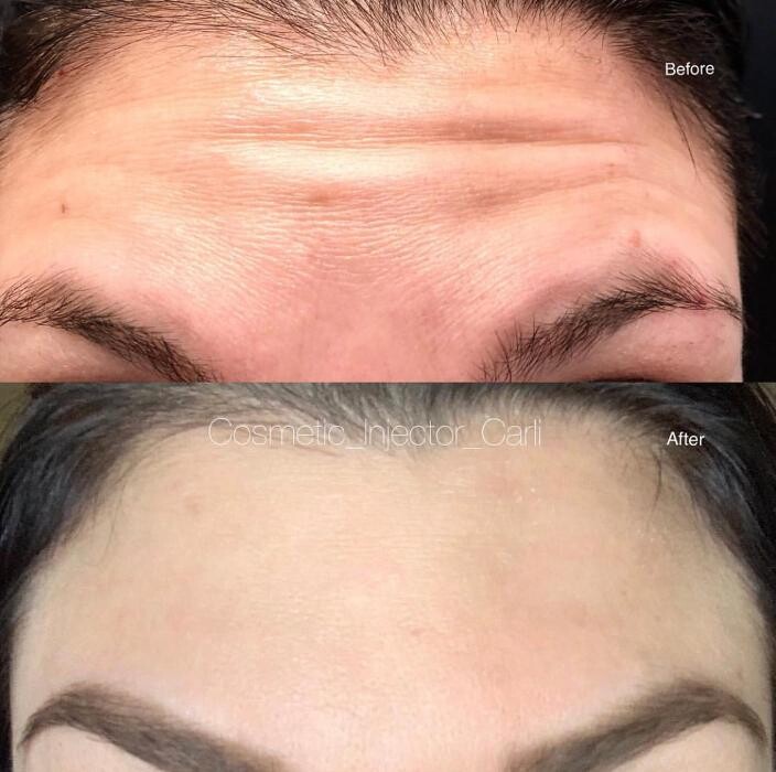 Images Lux Injections